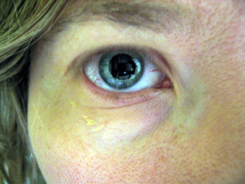 Alyce with dilated eye (Click to enlarge)